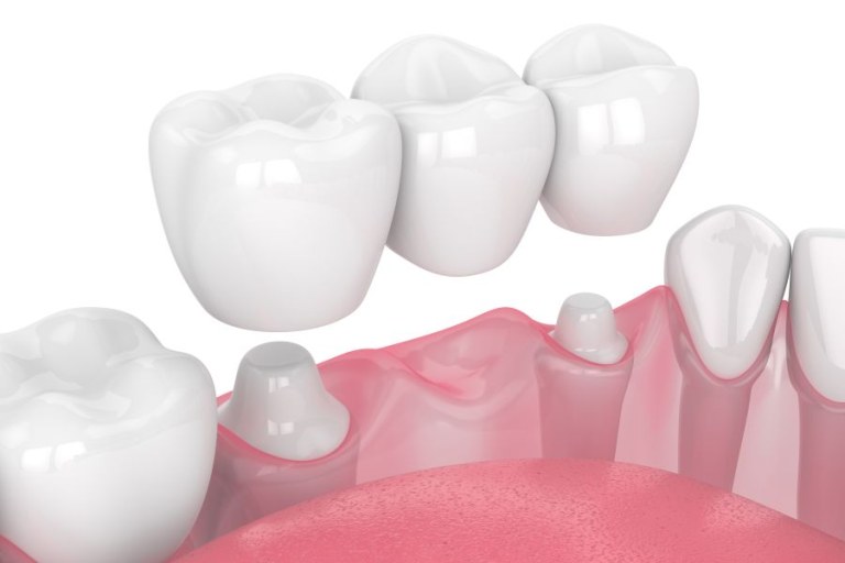crown and bridges dentist