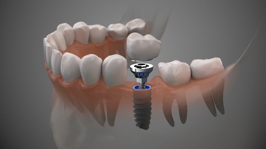 dental implant clinic