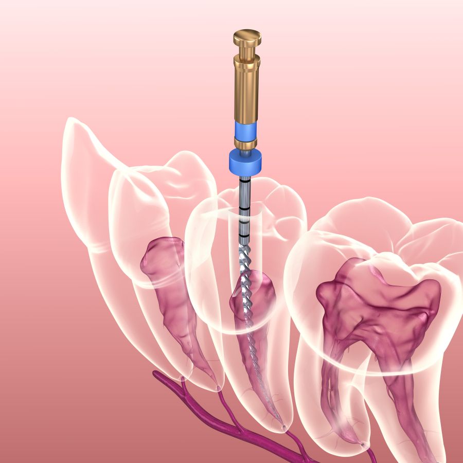 root canal procedure