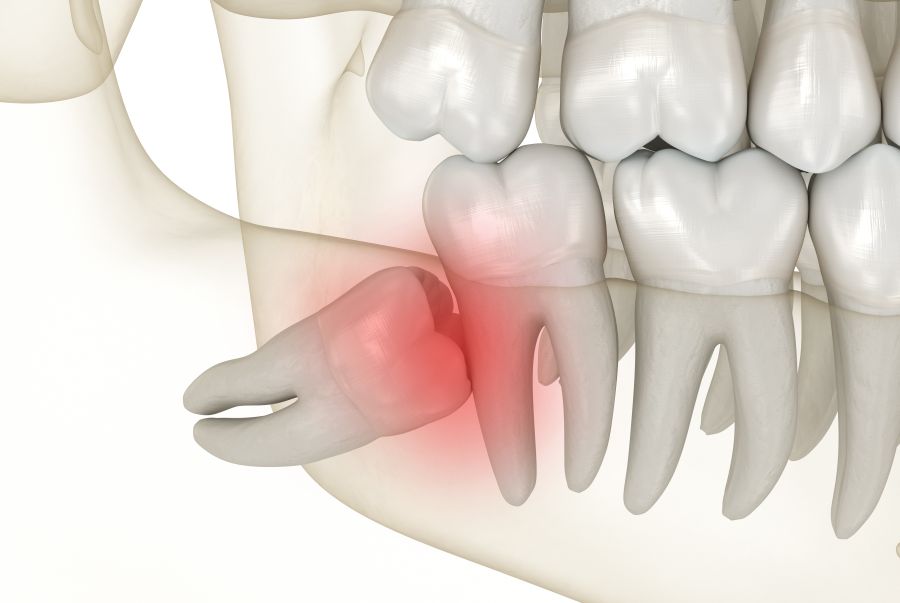 wisdom tooth impaction